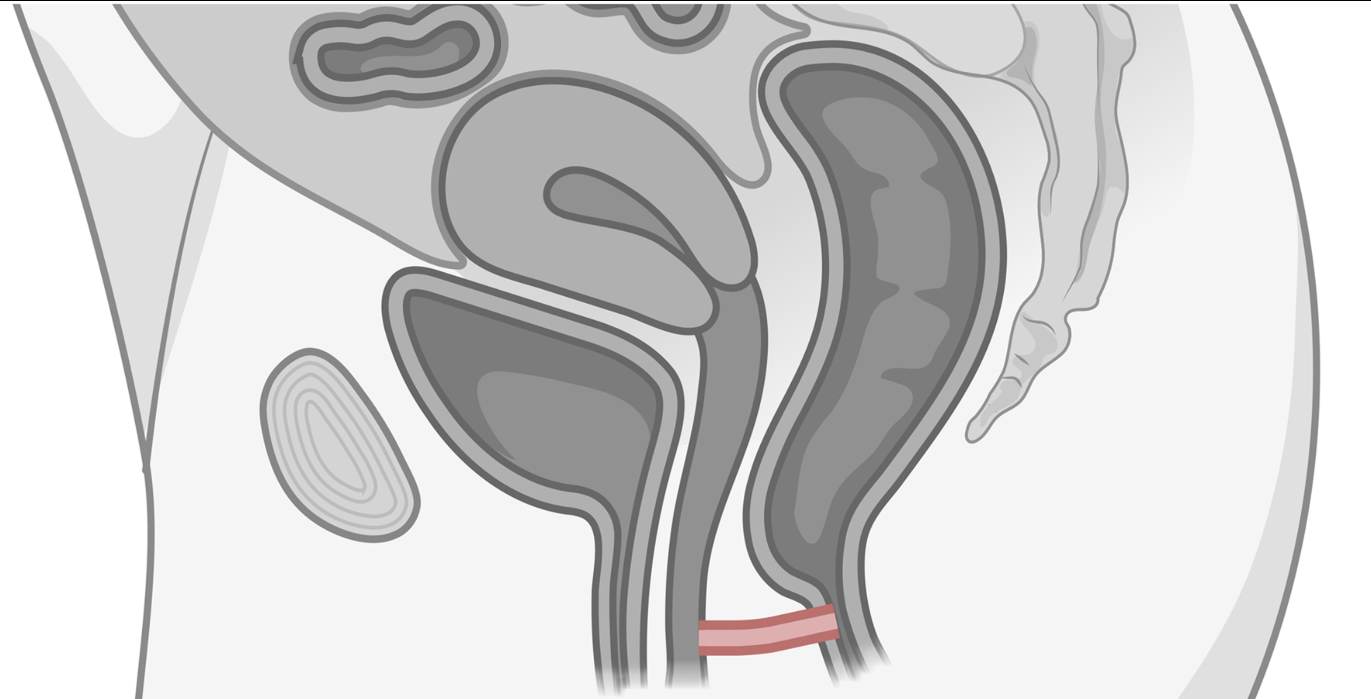 Pelvic Reconstructive Surgery
